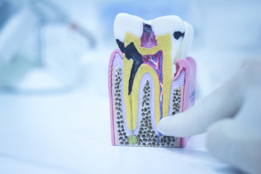 Denists Against Root Canals